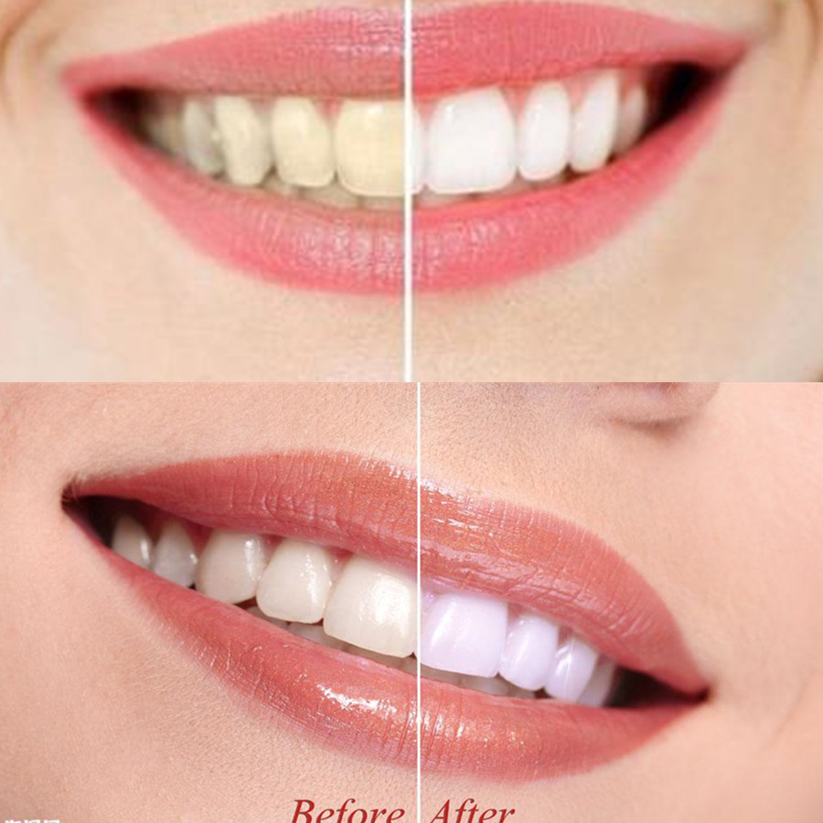Than Tre Răng Răng Nha Khoa De - đánh giá và giá Teeth Whitening Ingredients