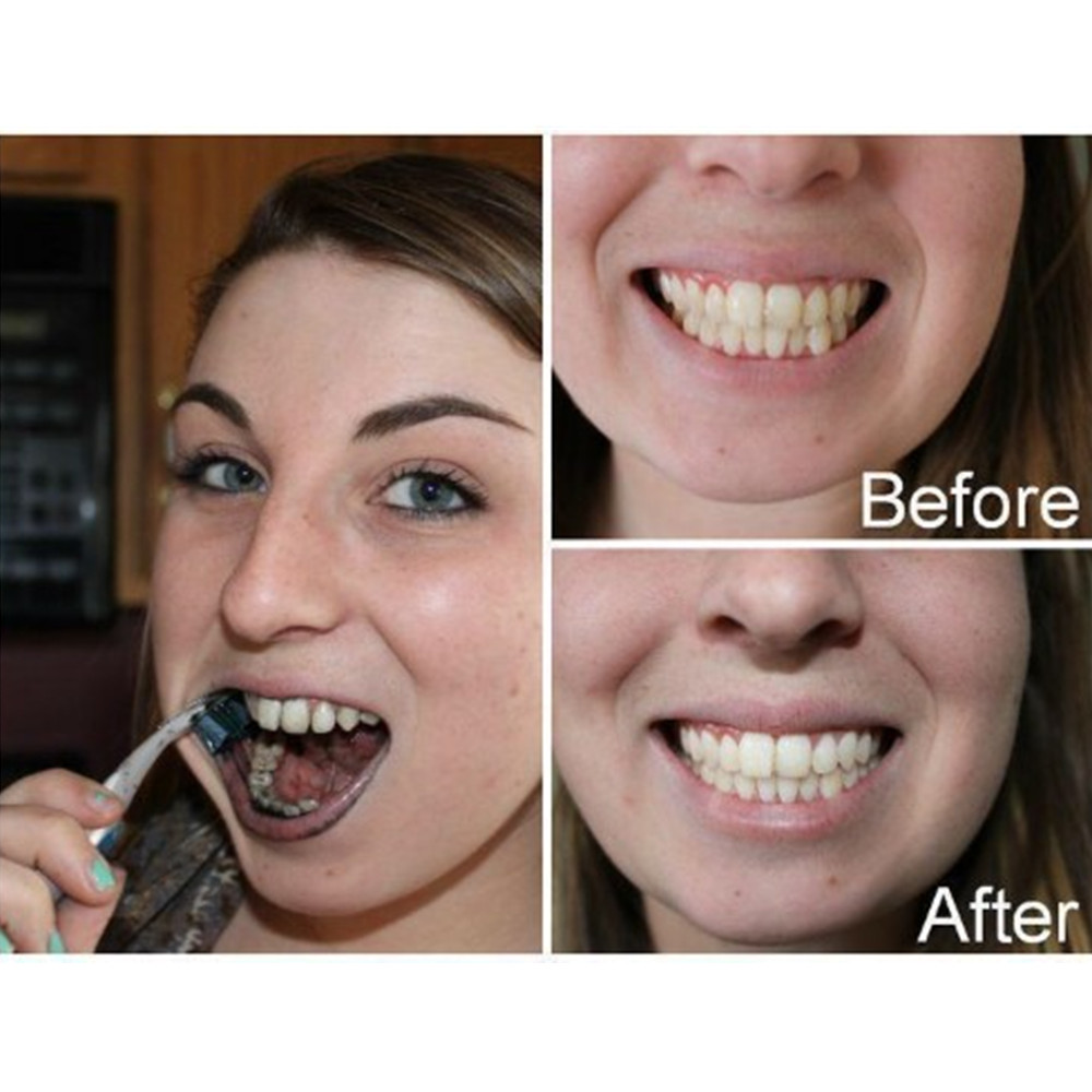Than Tre Răng Răng Nha Khoa De - đánh giá và giá Teeth Whitening Ingredients