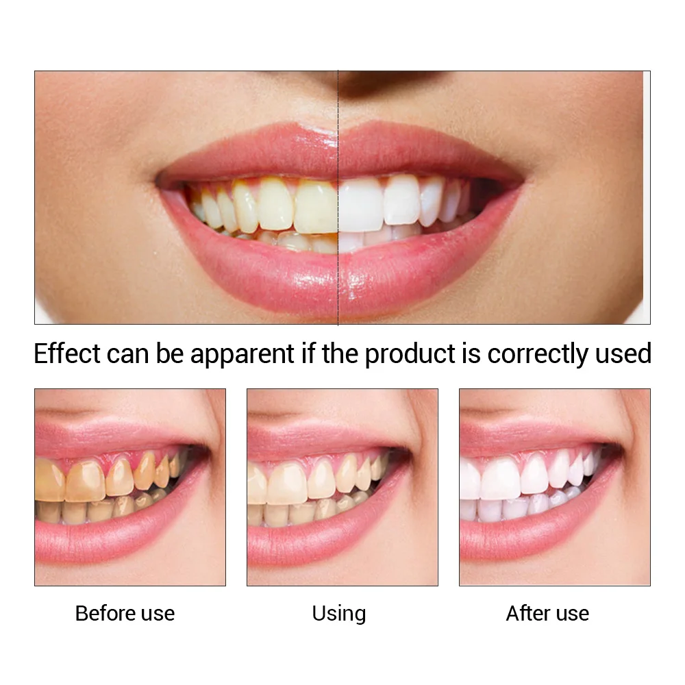 FTEENPLY Làm Trắng Răng Tinh C - đánh giá và giá Teeth Whitening Flash