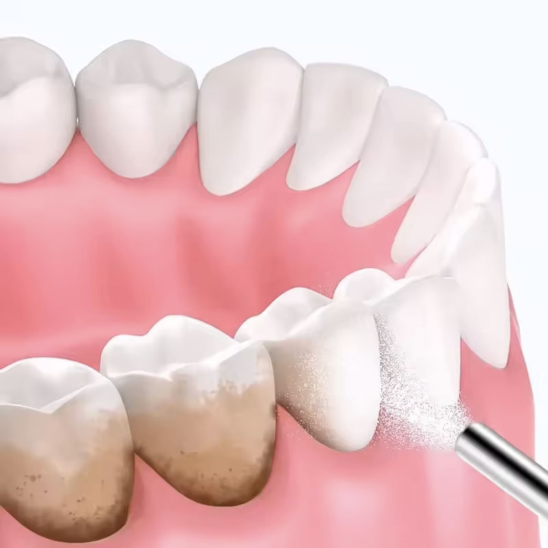 130g Dental Sandblasting Powde - đánh giá và giá Teeth Whitening Ingredients